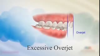 ایمپلنت دیجیتال چیست و چطور انجام می‌شود؟ | دکتر حامد صالحی