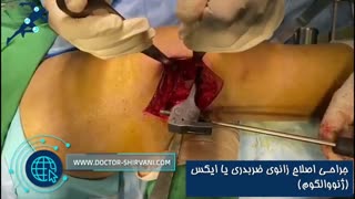 فیلم جراحی زانوی ضربدری
