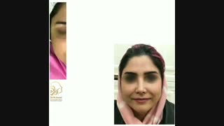 نتیجه جراحی یک ماه بعد از عمل