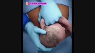 ویدئو واقعی زایمان سزارین