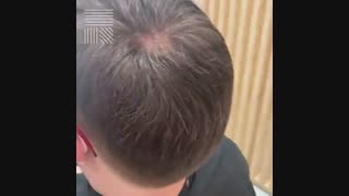 پروتز مو دائم در تهران و کرج 09198858620