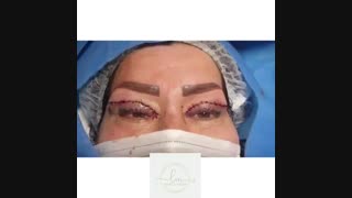 جراحی زیبایی پلک بالا