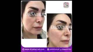 فیلر میدفیس