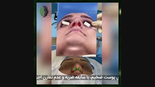 جراحی اولیه بینی با پوست ضخیم با سابقه ضربه | دکتر باستانی نژاد