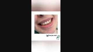 برداشت کامپوزیت ونیر تزریق چربی