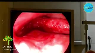 فیلم دیده نشده از مراحل درمان هیرمان