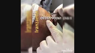 آموزش کاشت مو مجازی یا حضوری 