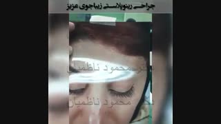 جراحی پلاستیک بینی دکتر محمود ناظمیان کاشت ابرو