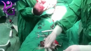 تولد آرتمیس کوچولو به روش زایمان سزارین