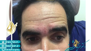 بوتاکس پیشانی