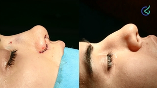 فیلم جراحی بینی قوزدار