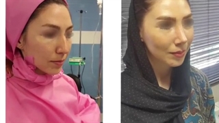 فیلم واقعی عمل بینی با انحراف شدید و نتیجه آن