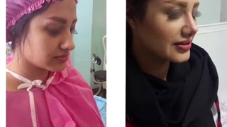 نمونه کار واقعی جراحی بینی گوشتی بزرگ 2 هفته بعد از عمل