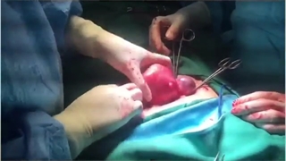 جراحی فیبروم