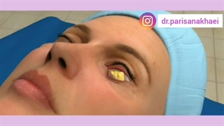 ویدئو واقعی عمل بلفاروپلاستی تحتانی