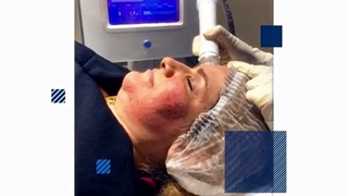 بهترین روش جوانسازی صورت با لیزر آر اف فراکشنال دندانپزشک زیبایی
