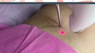 فیلم درمان قطعی واریس با لیزر فوتونا