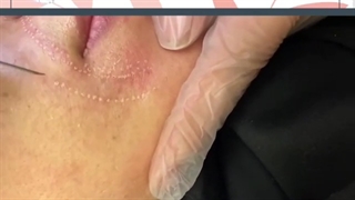 فیلم واقعی از بین بردن خط خنده با پلاسما