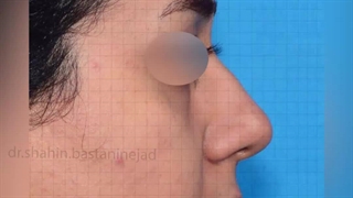 راینوپلاستی اولیه در بینی گوشتی و پیچدار | دکتر باستانی نژاد | جراح بینی