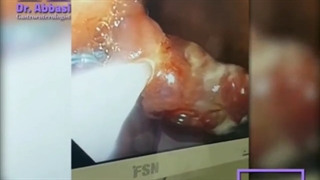 ویدئو واقعی برداشتن پولیپ بسیار بزرگ در معده بدون جراحی