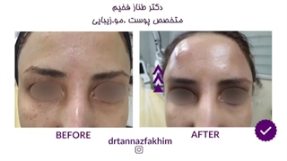 لیفت ابرو با نخ