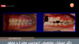 ارتودنسی فکین در بزرگسالان / متخصص ارتودنسی / دکتر جمیلیان