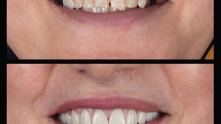 بهترین لمینت سرامیکی و ایمپلنت (دکتر بهمن پوراقدم)02122220000