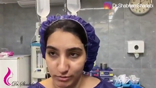 بلافاصله پس از جراحی بینی گوشتی