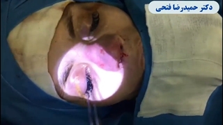 جراحی بینی برای سومین بار