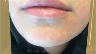 تزریق ژل لب و چانه