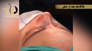 فیلم واقعی عمل زیبایی بینی، بلافاصله پس از عمل تا یک هفته بعد