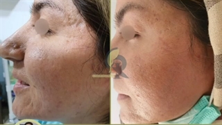 سابسیژن و پیلینگ نقطه ای جراحی زیبایی پلک