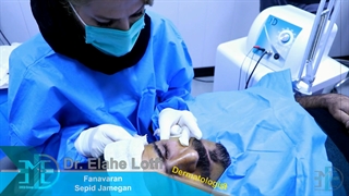 دستگاه Endo-RF Subcision