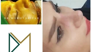یک ماه پس از جراحی زیبایی بینی گوشتی با غضروفهای ضعیف