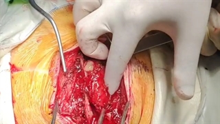 تومور بافت نرم و استخوان مهره توراسیک در دختر جوان