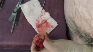 فیلم جراحی تومور مغزی