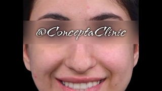 درمان ارتودنسی ثابت دو فک | کلینیک تخصصی دندانپزشکی کانسپتا