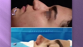 نمونه کار جراحی بینی | دکتر رفیع | جراح بینی تهران