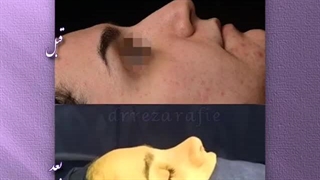 نمونه کار جراحی زیبایی بینی دکتر رضا رفیع | بهترین جراح بینی تهران