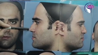 فیلم واقعی جراحی بینی گوشتی با انحراف شدید در اتاق عمل