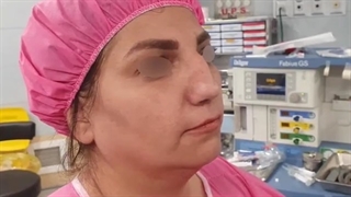 فیلم واقعی عمل بینی خانم ۴۳ ساله با انحراف شدید و مشکل تنفسی