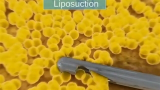 بارداری بعد از ابدومینوپلاستی اتوپلاستی