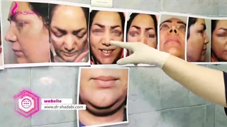 بلافاصله پس از جراحی بینی در اتاق عمل