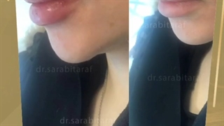 قبل و بعد تزریق ژل لب روسی