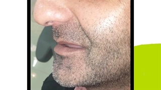 کاشت دندان - دکتر امیر محمدی-۰۹۱۲۰۹۵۷۰۱۳