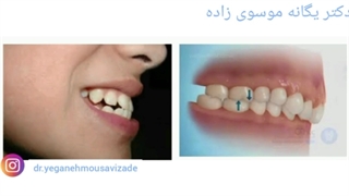 لیمنت های سرامیکی