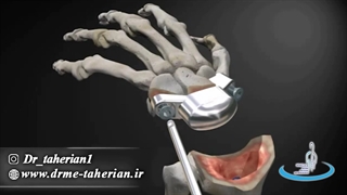 تعویض مفصل مچ دست | متخصص ارتوپد | دکتر محمد ابراهیم طاهریان