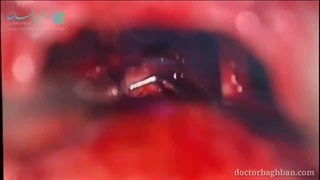 نورالژی عصب سه قلو سمت راست