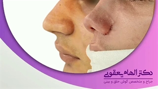 بلافاصله پس از عمل جراحی بینی