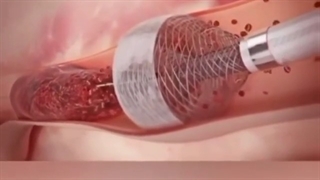 فیلم خروج لخته از داخل رگ